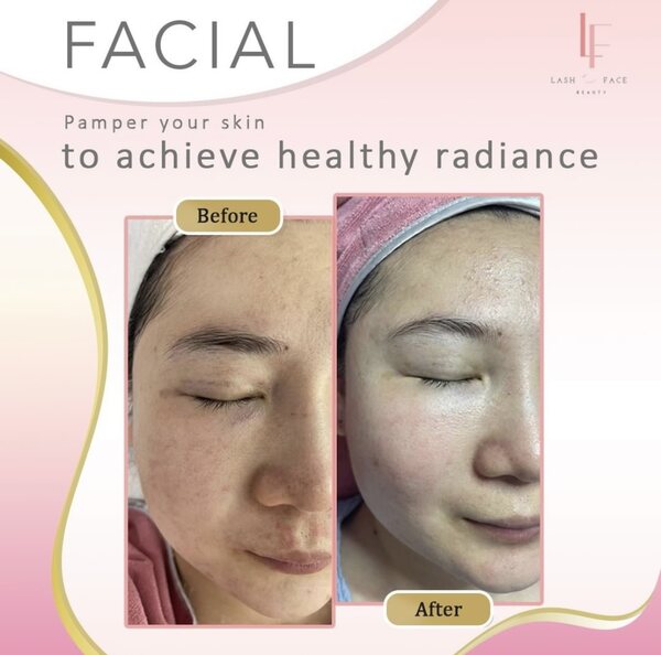 Best Facial Treatment For AcneProne Skin