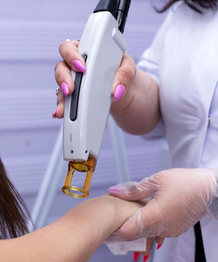 SHR Laser Hair Removal Singapore Leg/Armpit/Brazilian Hair Removal