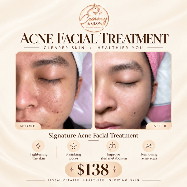 acne_facial